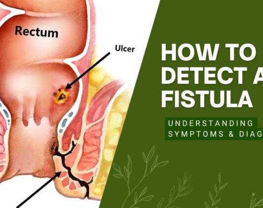 fistula fistula